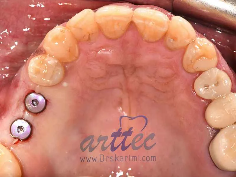 ایمپلنت How to implant a back tooth