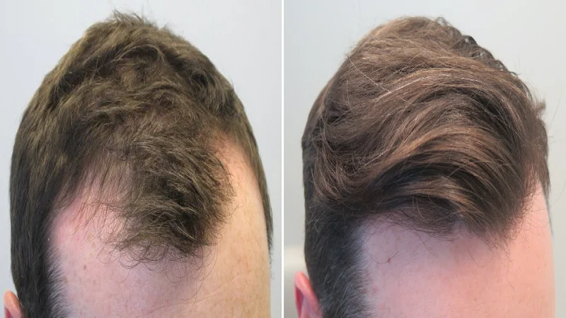 Finasteride side effects in men