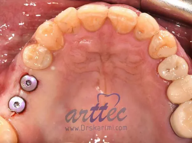 How to implant a back tooth