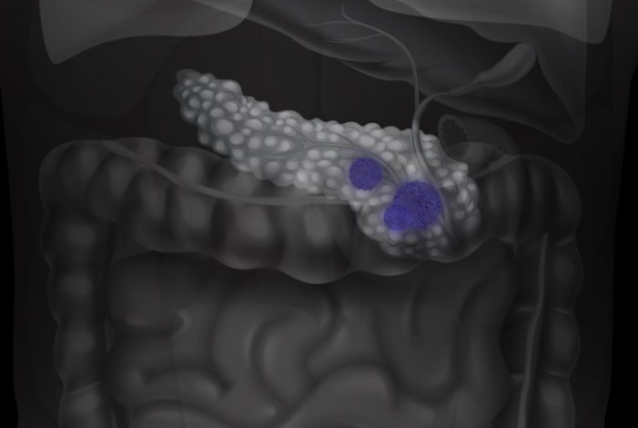 قاتل خاموش؛ نشانه‌ های هشدار دهنده سرطان پانکراس را بشناسید