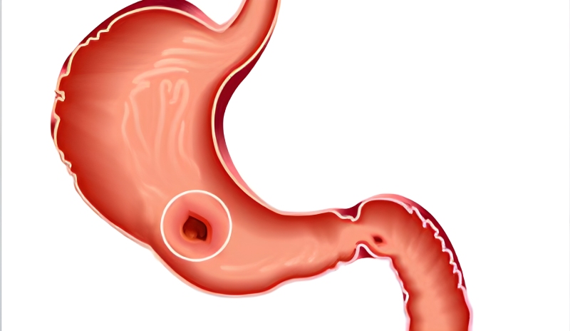 قطع دارو پس از درمان زخم معده: نکات ضروری و راهنمای کامل
